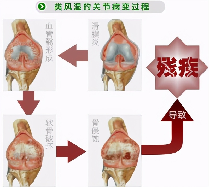 这些病症你中了几项?超过4项患类风湿性关节炎的几率极高